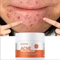 Herbal Acne Treatment Cream Anti — Swuffy