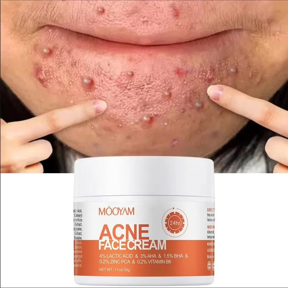 Herbal Acne Treatment Cream Anti — Swuffy